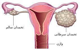سرطان تخمدان