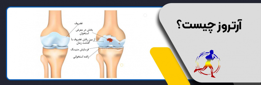 آرتروز چیست؟