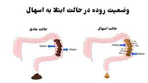 اسهال و راه های درمان آن