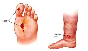 دلایل بروز زخم دیابتی+ فیلم
